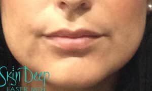 After Image: Lip Augmentation