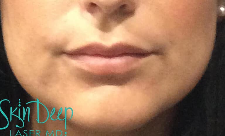After Image: Lip Augmentation - front
