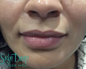 Before Image: Lip Augmentation