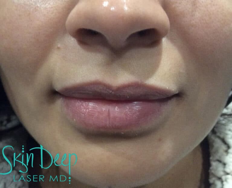 Before Image: Lip Augmentation - front
