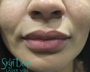 After Image: Lip Augmentation