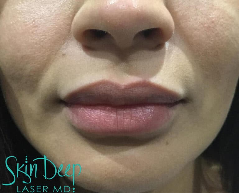 After Image: Lip Augmentation - front