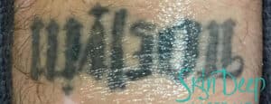 Before Image: Laser Tattoo Removal