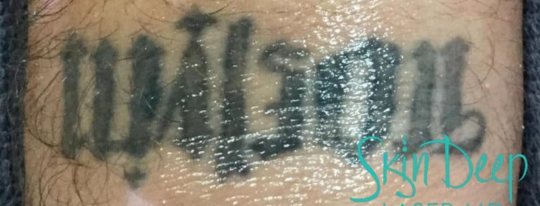 Before Image: Laser Tattoo Removal - front