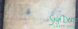 After Image: Laser Tattoo Removal