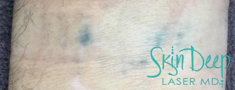 After Image: Laser Tattoo Removal - front