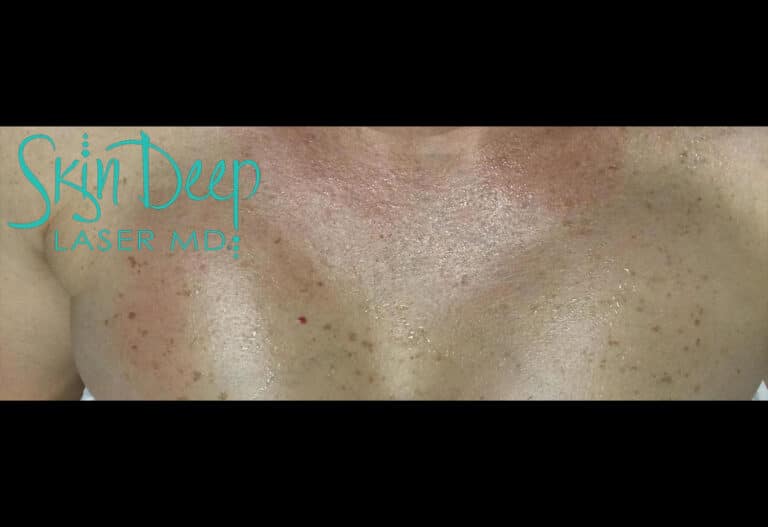 Before Image: Pigment & Redness - front