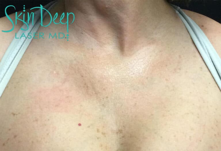 After Image: Pigment & Redness - front