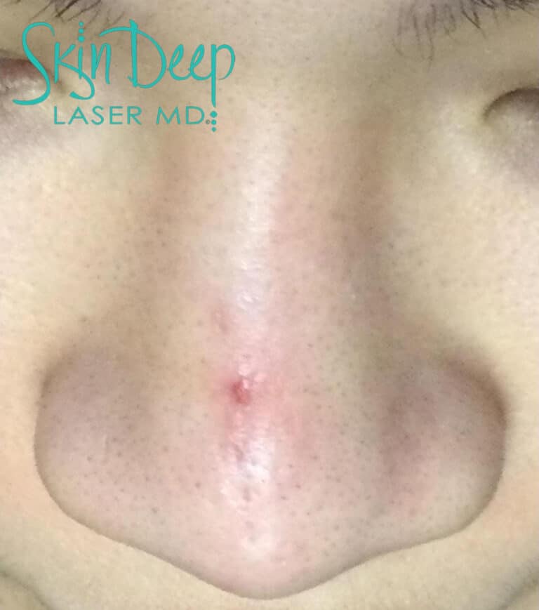 Before Image: Scars & Stretch Marks - front