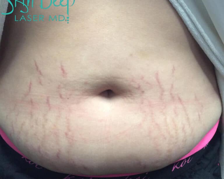 Before Image: Scars & Stretch Marks - front