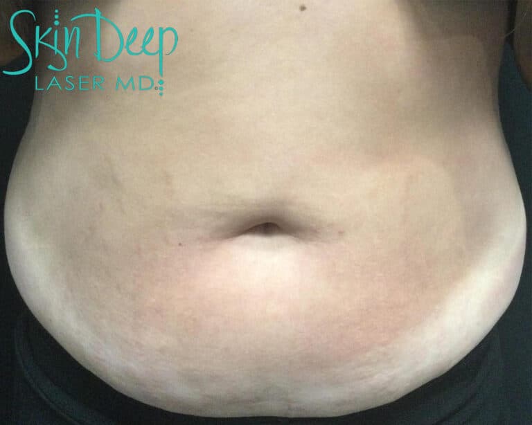After Image: Scars & Stretch Marks - front