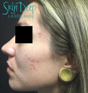 Before Image: Scars & Stretch Marks