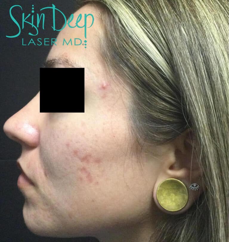 Before Image: Scars & Stretch Marks - left-side