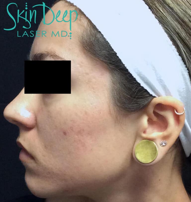After Image: Scars & Stretch Marks - left-side