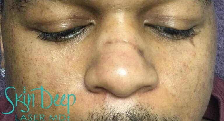 Before Image: Scars & Stretch Marks - front