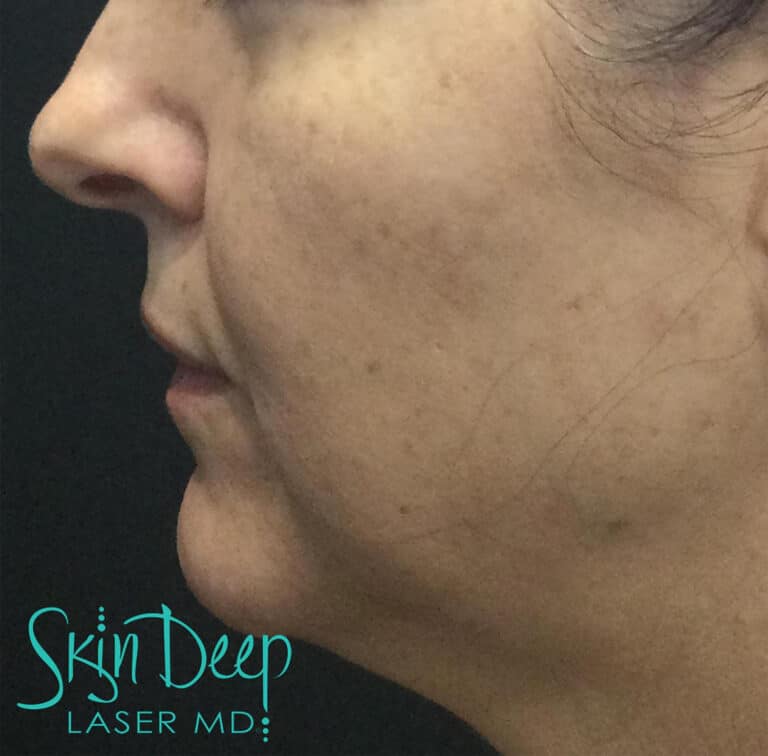 Before Image: Pigment & Redness - left-side