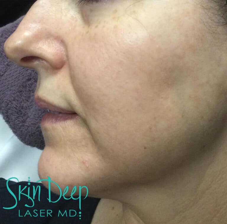 After Image: Pigment & Redness - left-side