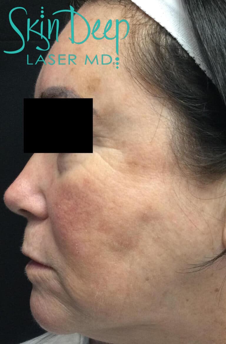 Before Image: Pigment & Redness - left-side