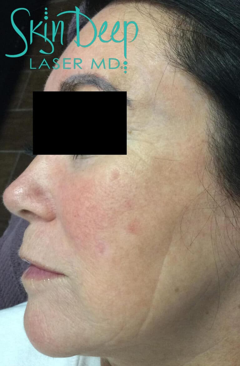 After Image: Pigment & Redness - left-side