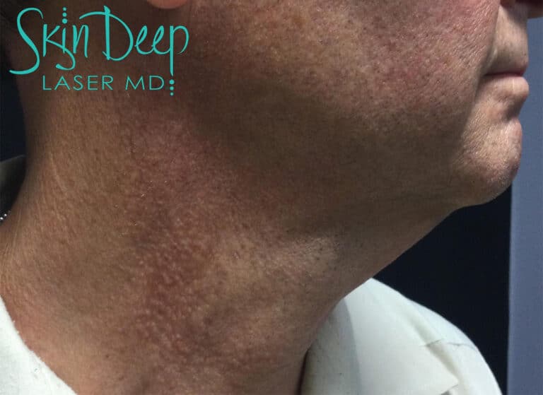 Before Image: Pigment & Redness - right-side