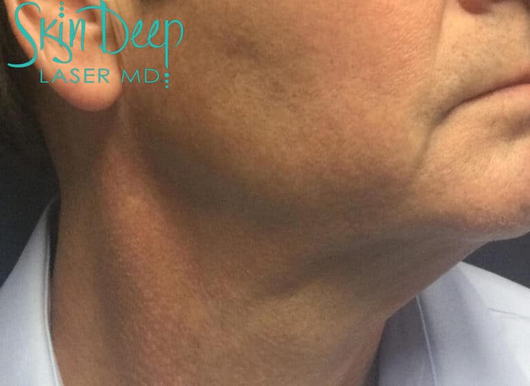 After Image: Pigment & Redness - right-side