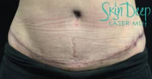 Before Image: Scars & Stretch Marks