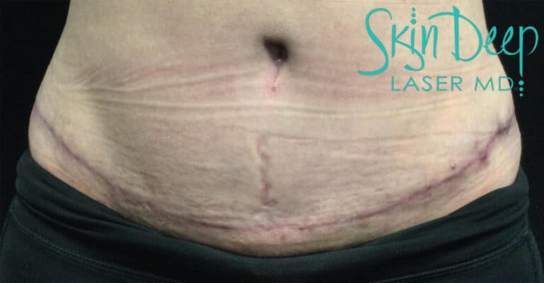 Before Image: Scars & Stretch Marks - front