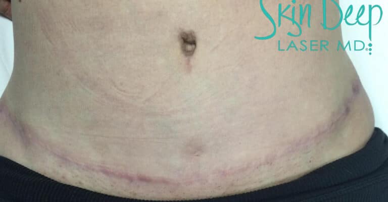 After Image: Scars & Stretch Marks - front