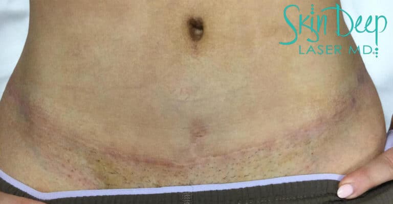 After Image: Scars & Stretch Marks - front