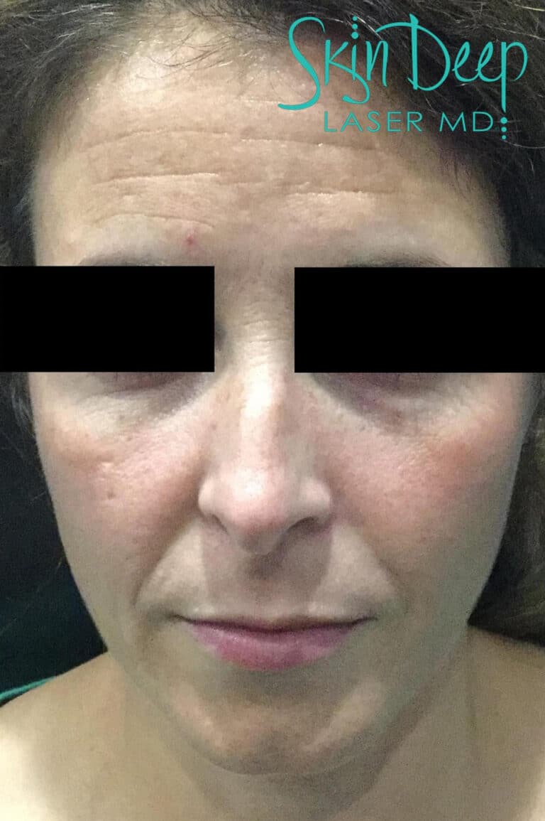 Before Image: Skin Rejuvenation - front