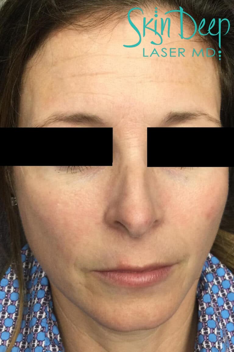 After Image: Skin Rejuvenation - front