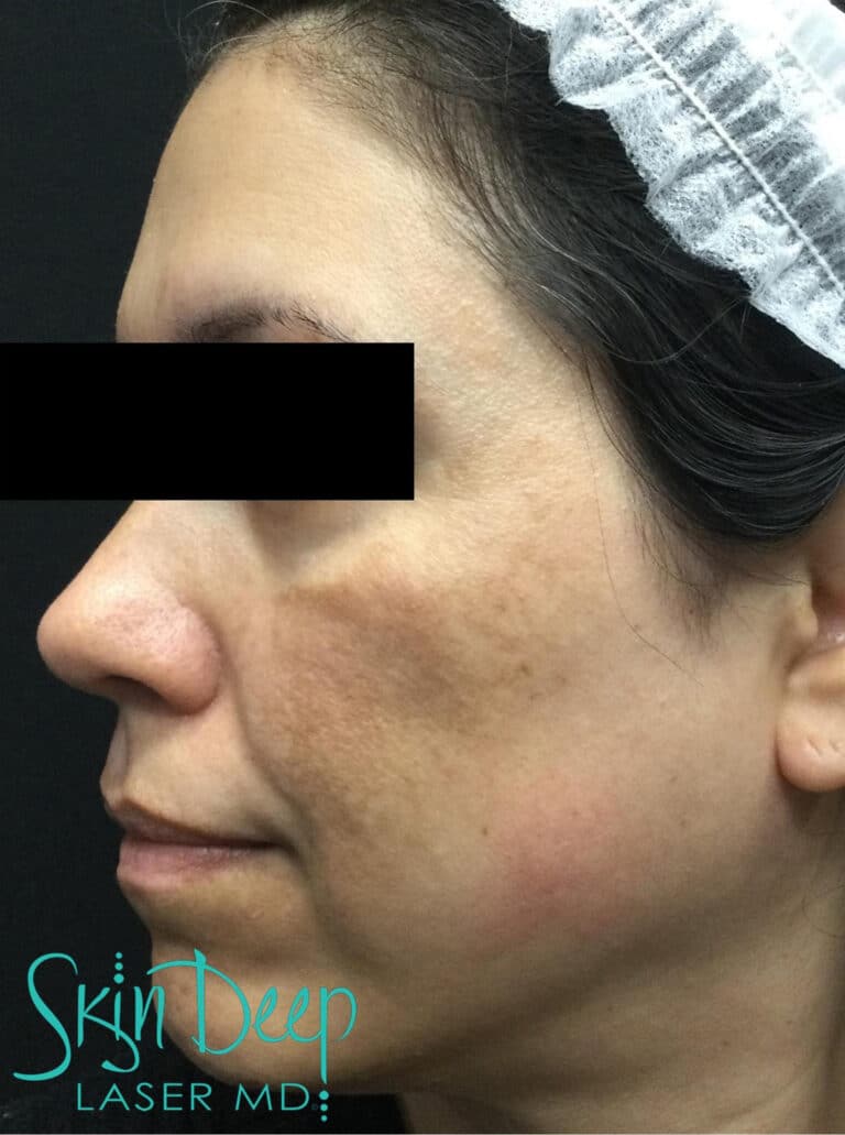 Before Image: Pigment & Redness - left-side
