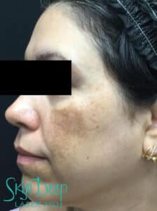 After Image: Pigment & Redness