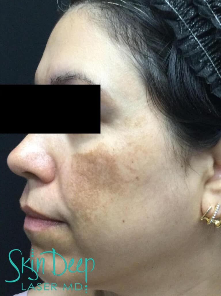 After Image: Pigment & Redness - left-side
