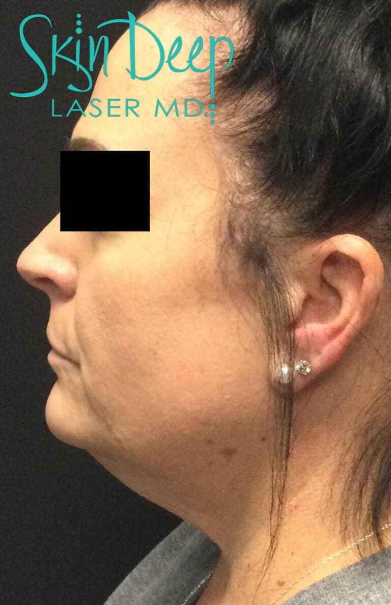 Before Image: SculpSure Double Chin Treatment - left-side