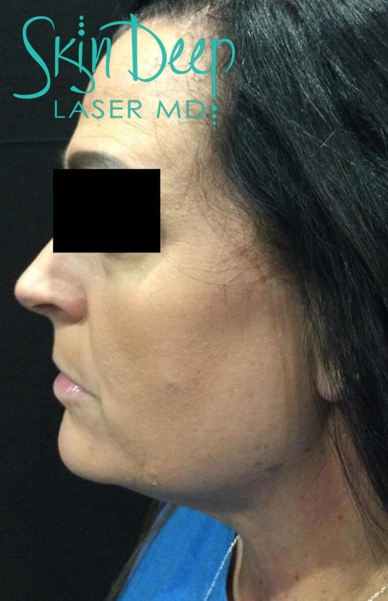 After Image: SculpSure Double Chin Treatment - left-side