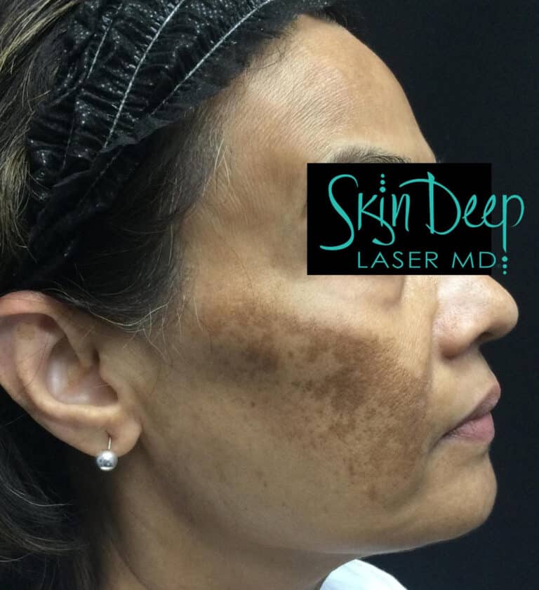 Before Image: Melasma - right-side