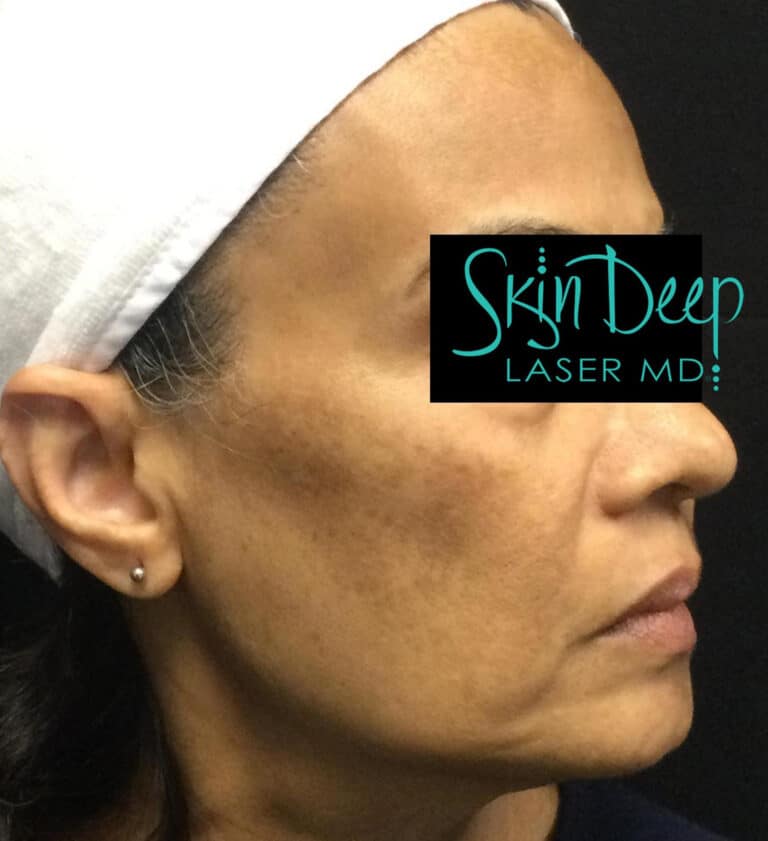 After Image: Melasma - right-side