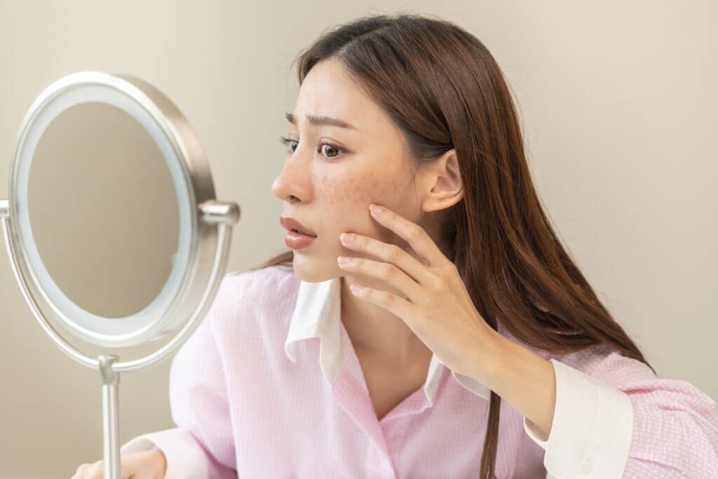 A woman with melasma looking in the mirror