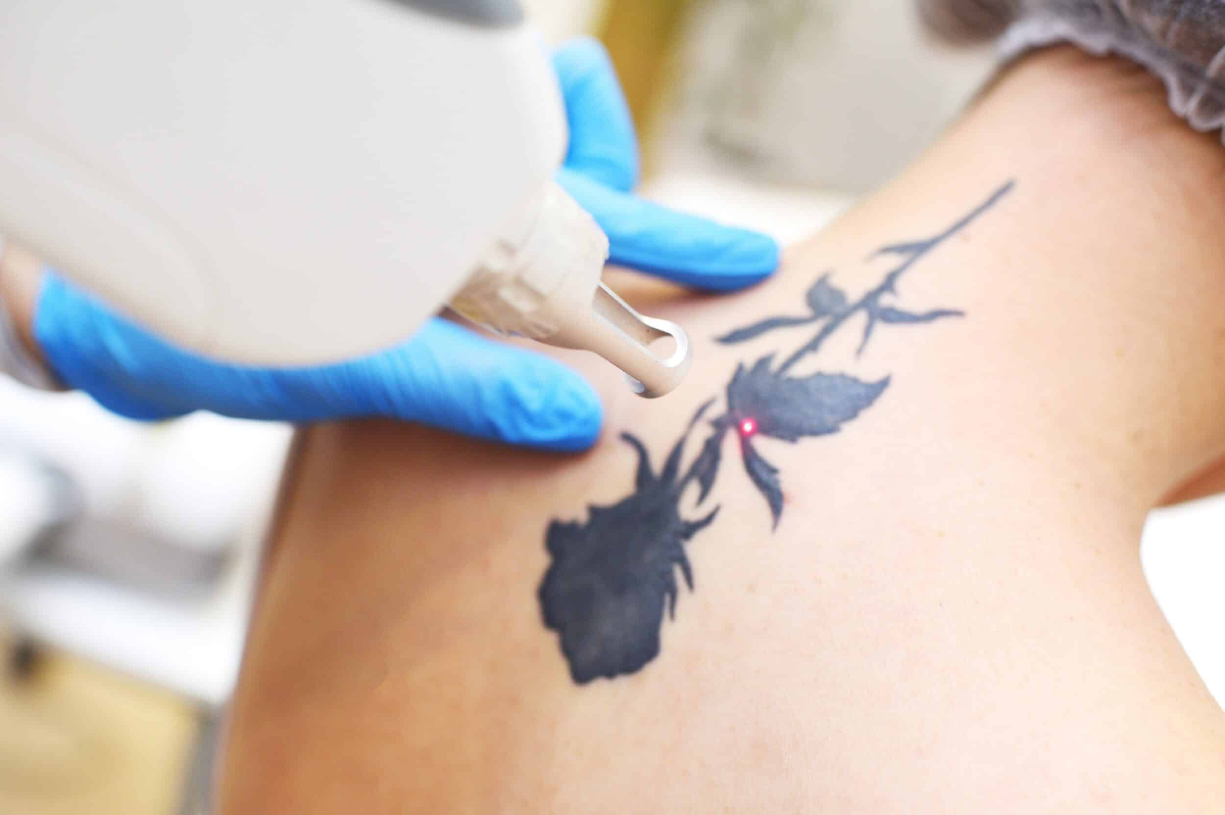 A patient undergoing tattoo removal on the back of their neck