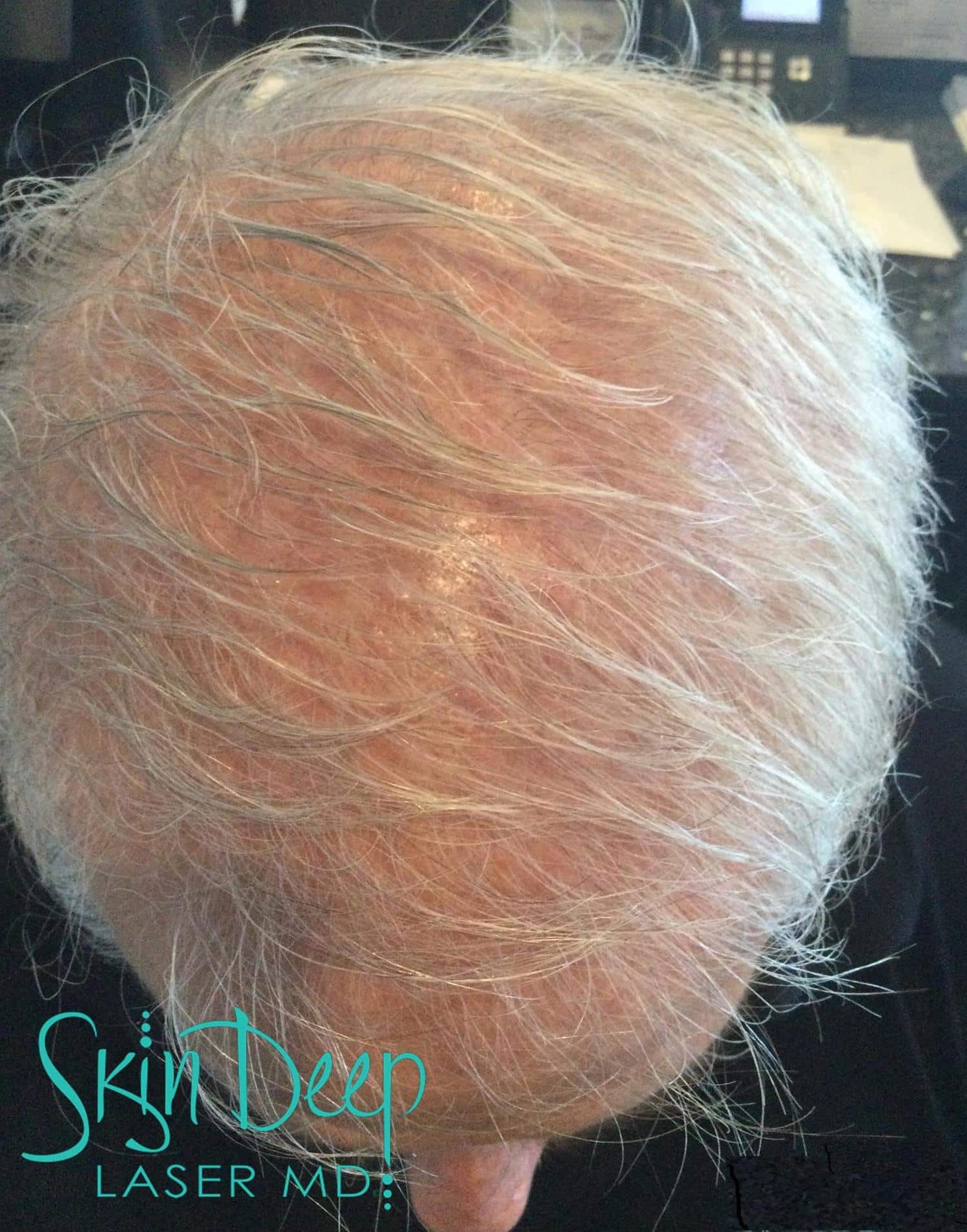PT 048 Hair Restor Before