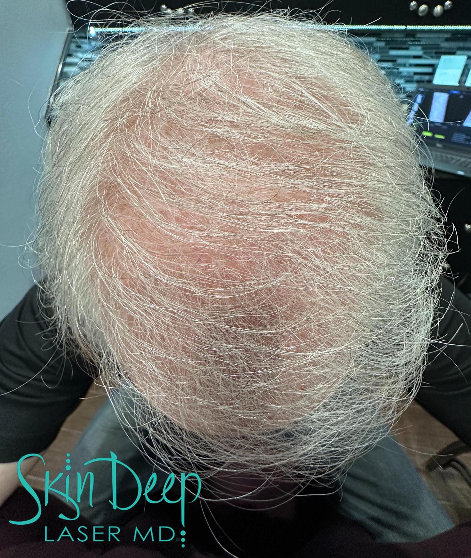 PT 048 Hair Restor Post 1 Tx