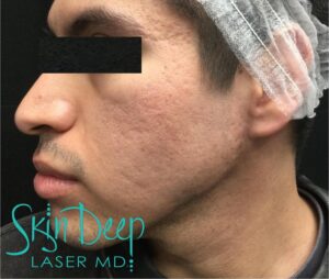 Before Image: Acne Scars