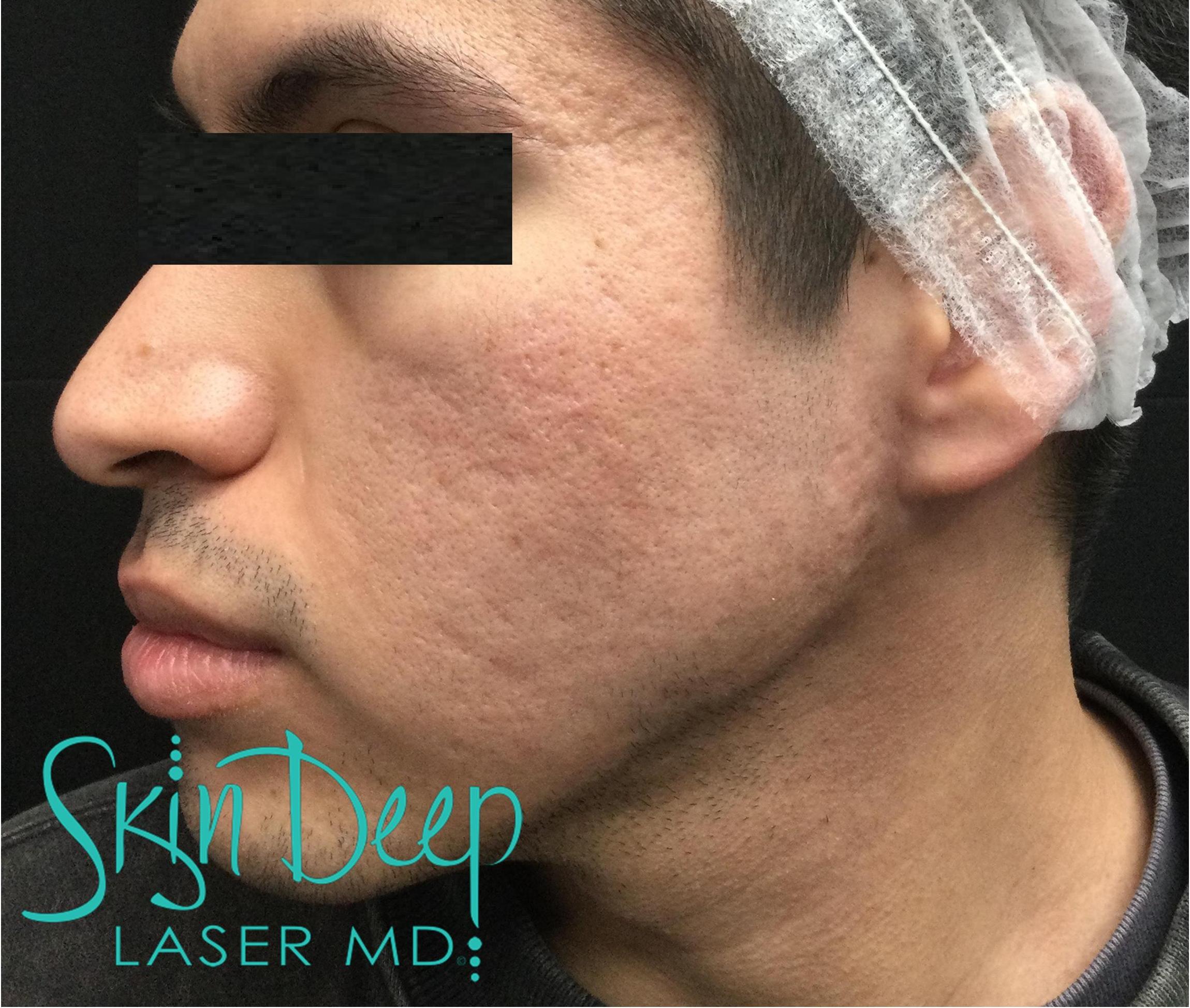 PT049 Acne Scars 1540 Before