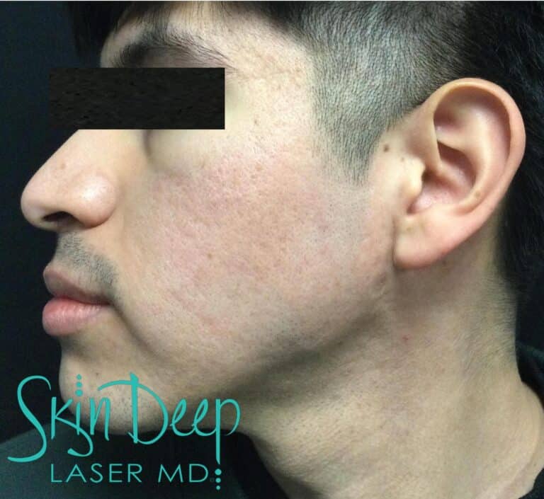 After Image: Acne Scars - left-side