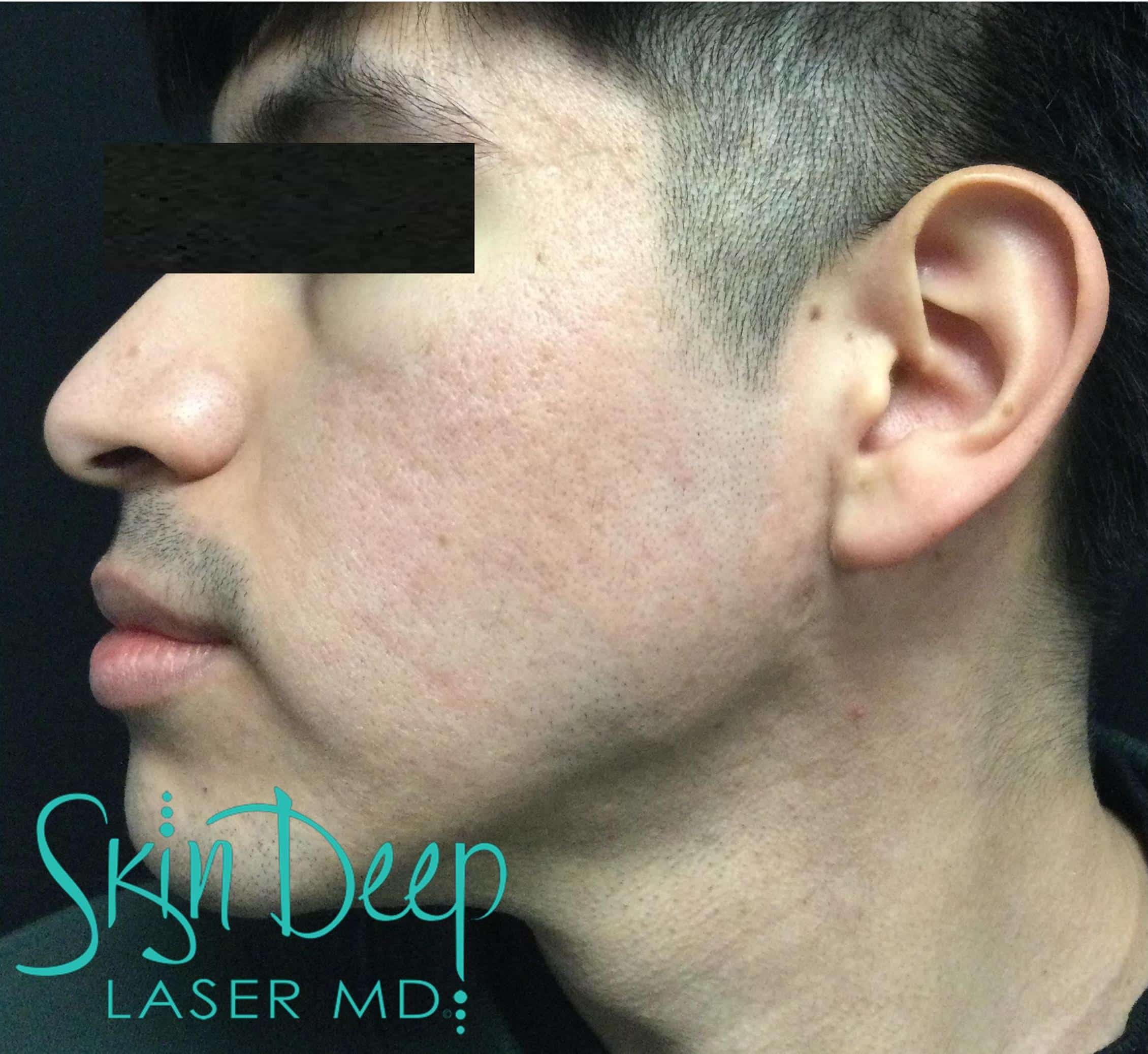 PT049 Acne Scars 1540 Post 1 Tx