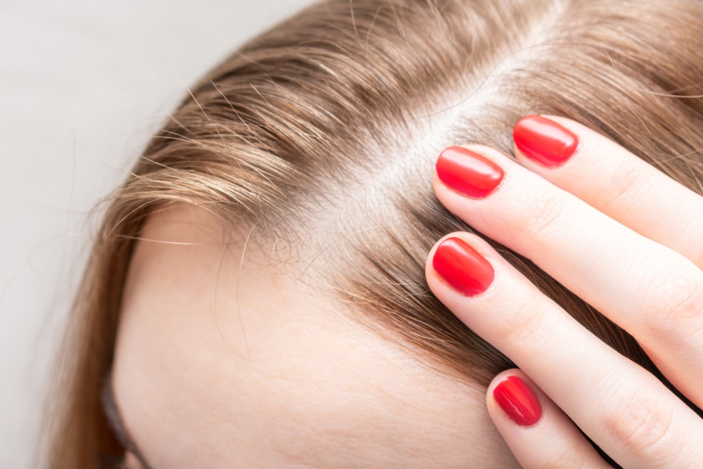 A close-up shot of a woman with hair thinning on her scalp