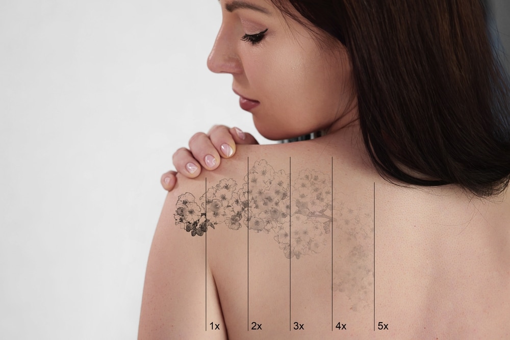 A tattoo progressively fading after laser tattoo removal treatments in Fort Worth