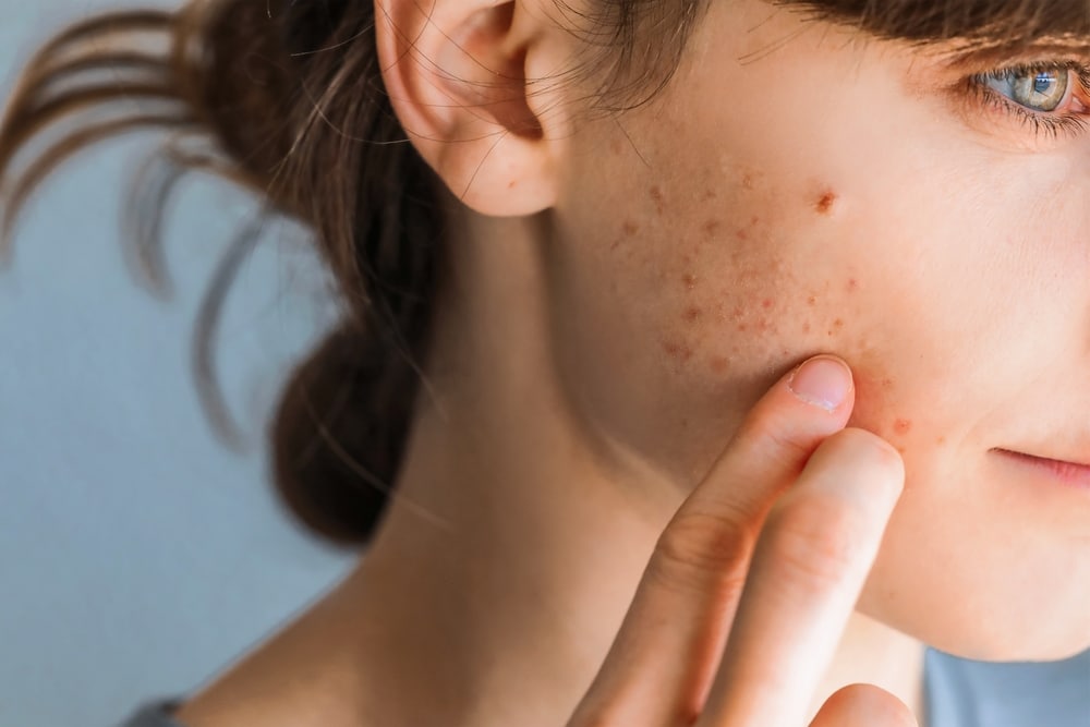 A close-up shot of a acne scars on a woman's cheek
