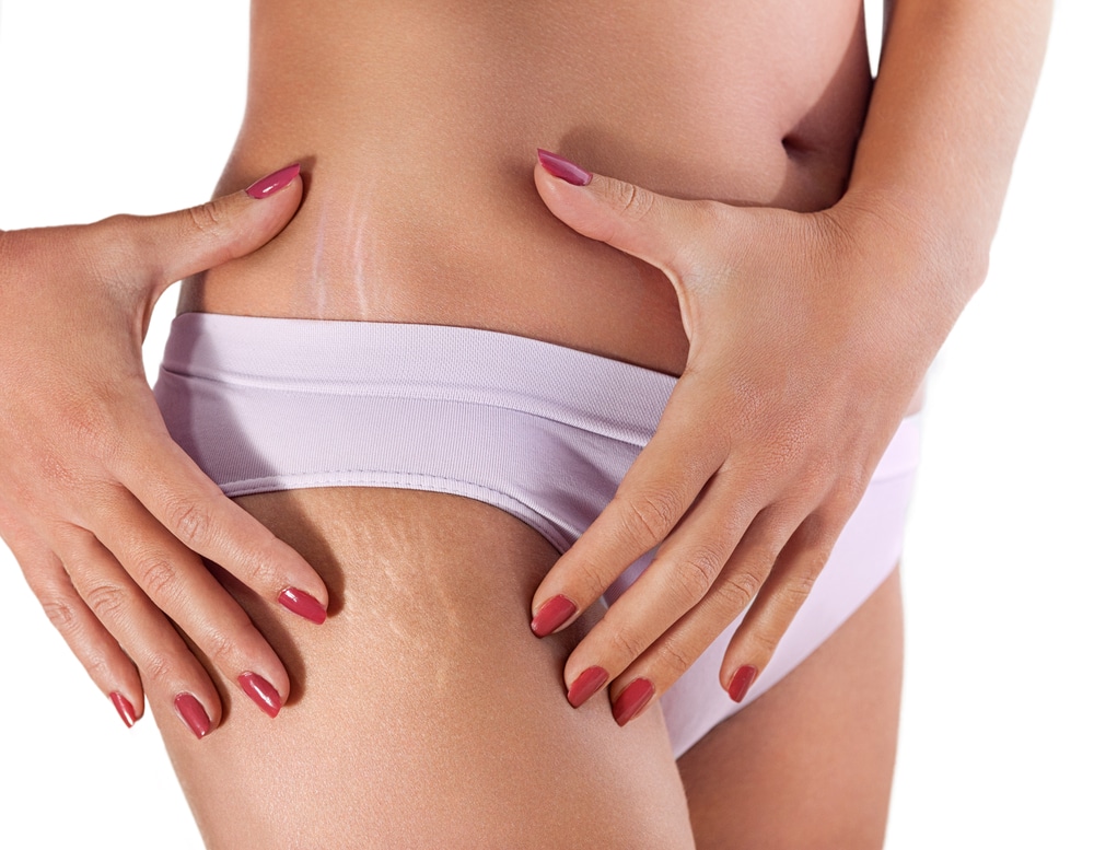 A close-up shot of stretch marks on a woman's thigh
